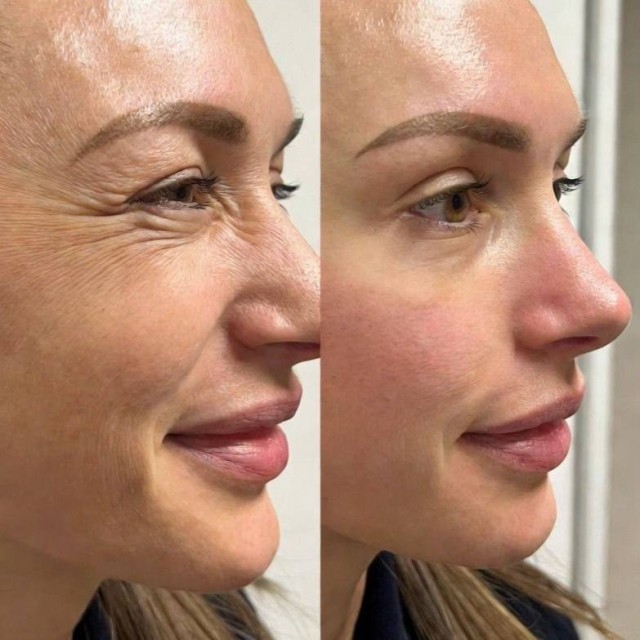 Terapia botulinowa całej twarzy. Trening indywidualny.